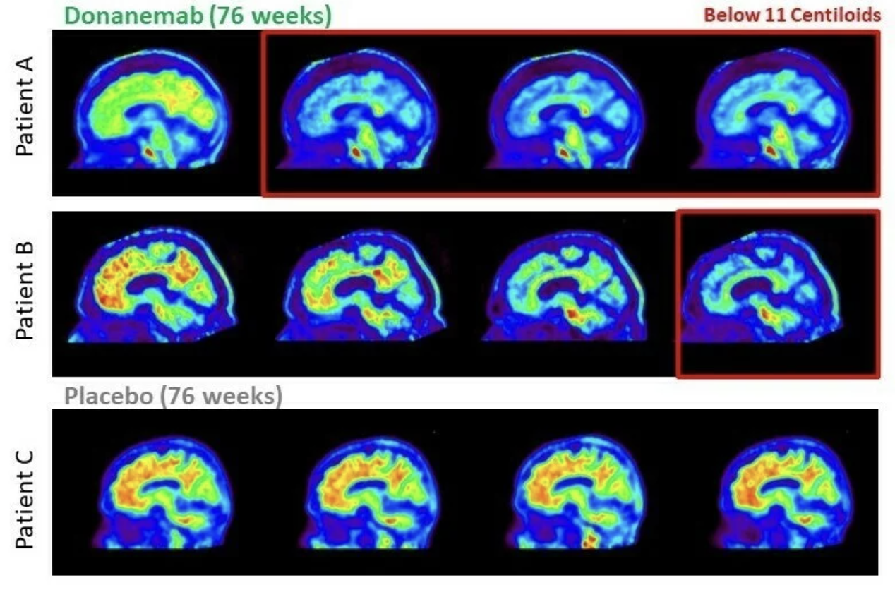 Tratamento Experimental para Alzheimer Supera Expectativas