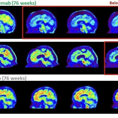 Tratamento Experimental para Alzheimer Supera Expectativas